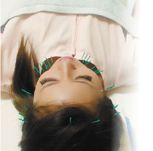 一般的な針よりさらに細い針をお顔の３０本程打つことにより、お肌の新陳代謝を高め、コラーゲン、エラスチンを活性化させ、お肌の内側からキレイになり、マイナス５歳若返らせる施術です。